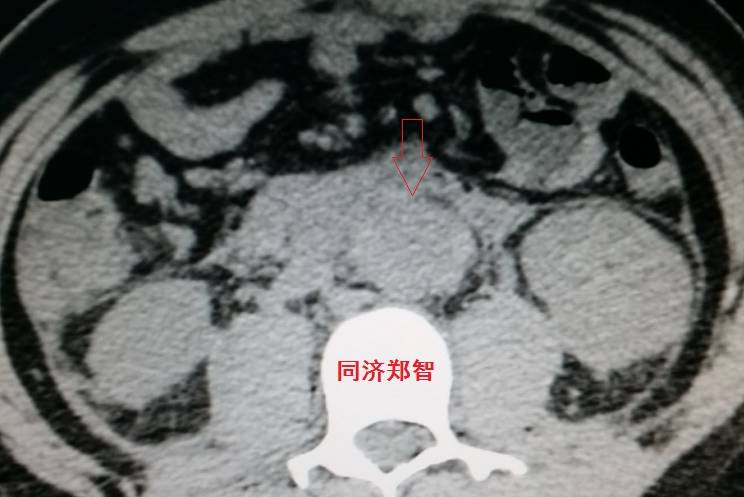 急性主动脉夹层cta影像诊断与鉴别,冠状动脉cta可以看到主动脉夹层吗