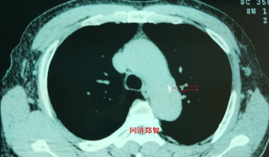 急性主动脉夹层cta影像诊断与鉴别,冠状动脉cta可以看到主动脉夹层吗
