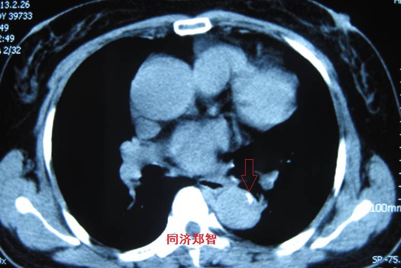 急性主动脉夹层cta影像诊断与鉴别,冠状动脉cta可以看到主动脉夹层吗
