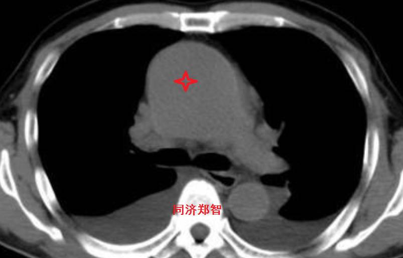 急性主动脉夹层cta影像诊断与鉴别,冠状动脉cta可以看到主动脉夹层吗