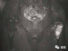 髋部疼痛做什么检查,左髋部疼痛待查病例