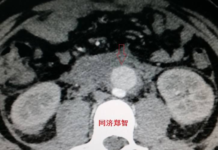 急性主动脉夹层cta影像诊断与鉴别,冠状动脉cta可以看到主动脉夹层吗