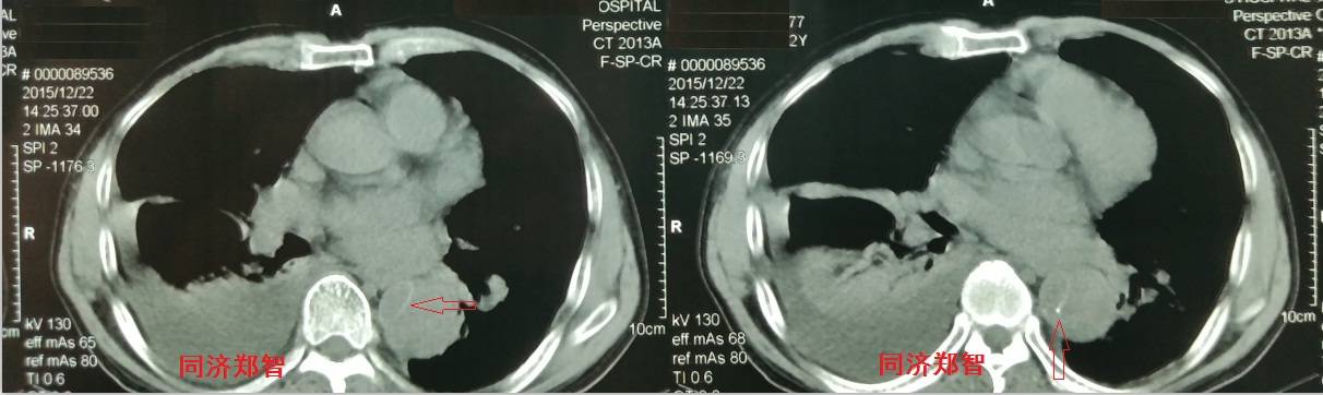 急性主动脉夹层cta影像诊断与鉴别,冠状动脉cta可以看到主动脉夹层吗