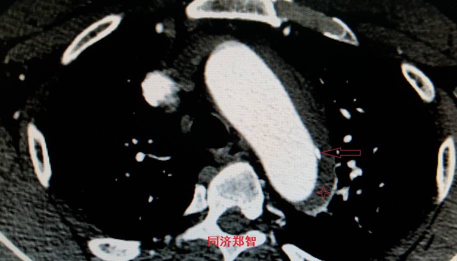 急性主动脉夹层cta影像诊断与鉴别,冠状动脉cta可以看到主动脉夹层吗