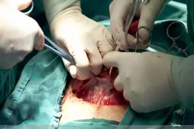 剖腹产全景记录,剖腹产恢复不同时期的照片