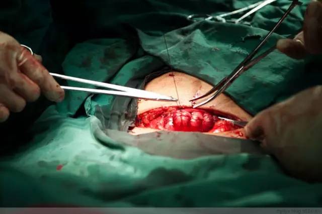 剖腹产全景记录,剖腹产恢复不同时期的照片