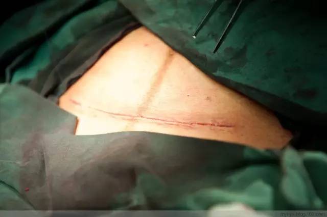 剖腹产全景记录,剖腹产恢复不同时期的照片