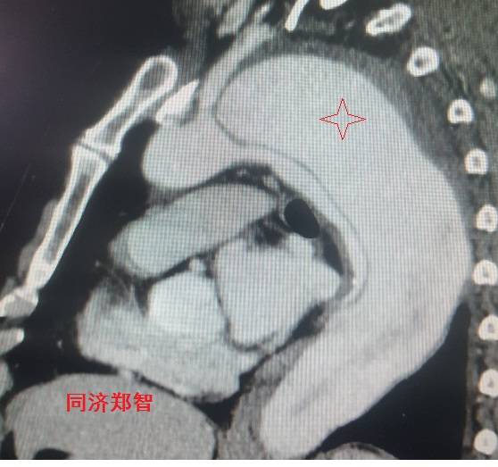 急性主动脉夹层cta影像诊断与鉴别,冠状动脉cta可以看到主动脉夹层吗