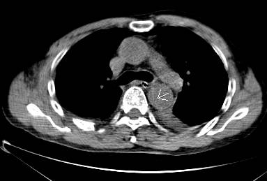 急性主动脉夹层cta影像诊断与鉴别,冠状动脉cta可以看到主动脉夹层吗