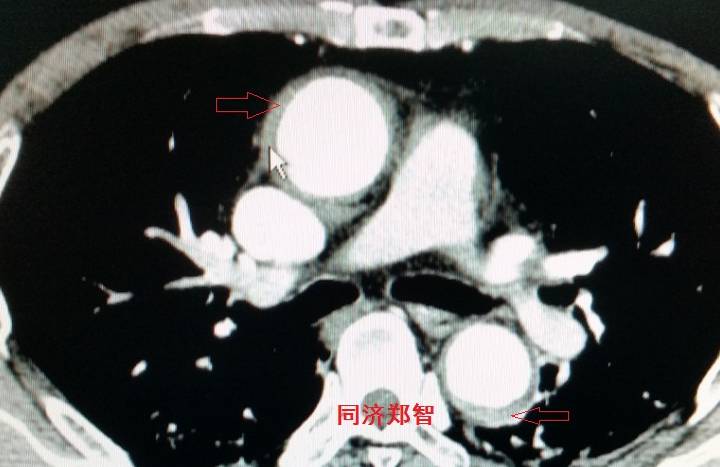 急性主动脉夹层cta影像诊断与鉴别,冠状动脉cta可以看到主动脉夹层吗