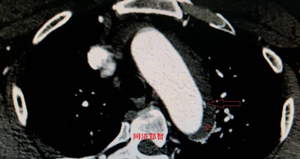 急性主动脉夹层cta影像诊断与鉴别,冠状动脉cta可以看到主动脉夹层吗