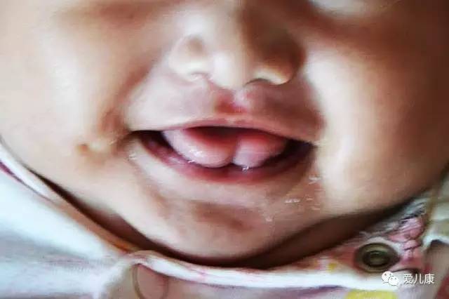 宝宝舌尖是w形,宝宝舌头是w形状是怎么回事