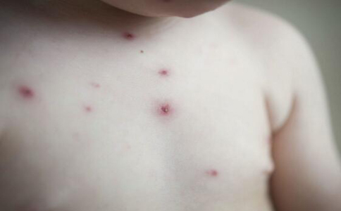 皮肤病的人不能吃什么调料,为什么皮肤病不能吃辛辣的食物