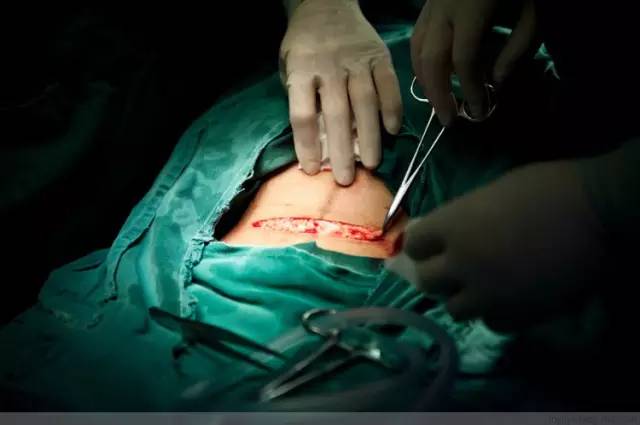 剖腹产全景记录,剖腹产恢复不同时期的照片