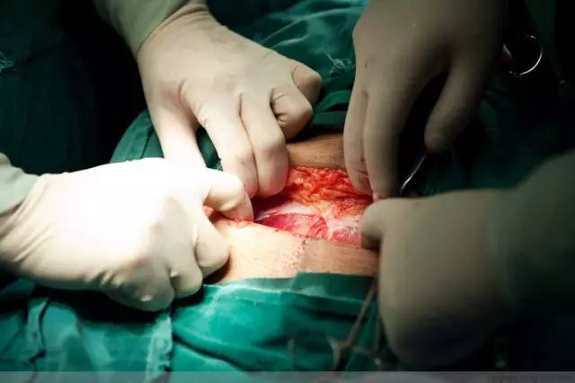 剖腹产全景记录,剖腹产恢复不同时期的照片