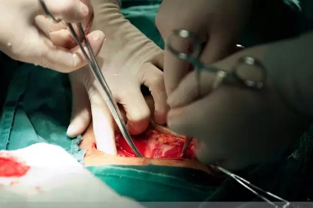 剖腹产全景记录,剖腹产恢复不同时期的照片