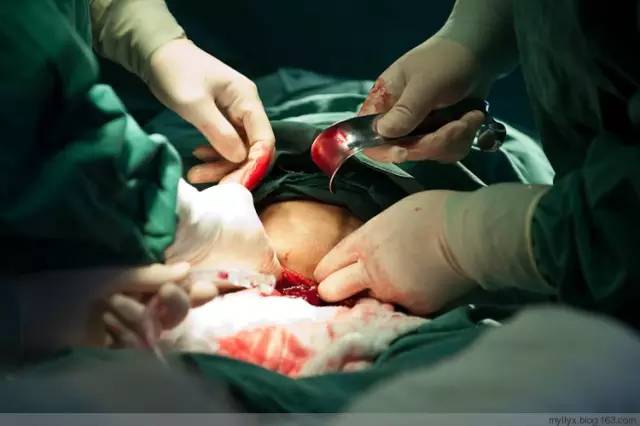 剖腹产全景记录,剖腹产恢复不同时期的照片