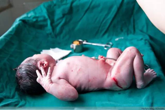 剖腹产全景记录,剖腹产恢复不同时期的照片