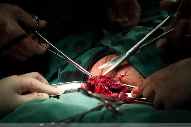 剖腹产全景记录,剖腹产恢复不同时期的照片