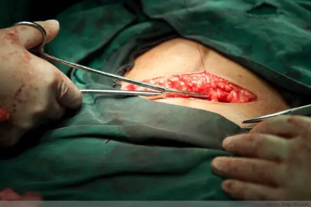 剖腹产全景记录,剖腹产恢复不同时期的照片