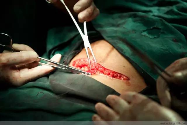 剖腹产全景记录,剖腹产恢复不同时期的照片