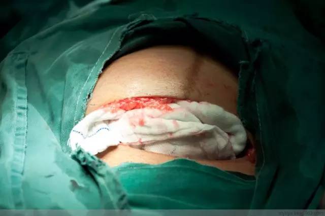 剖腹产全景记录,剖腹产恢复不同时期的照片