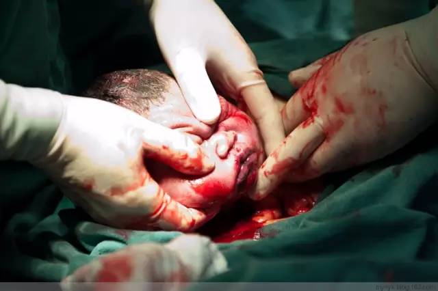 剖腹产全景记录,剖腹产恢复不同时期的照片