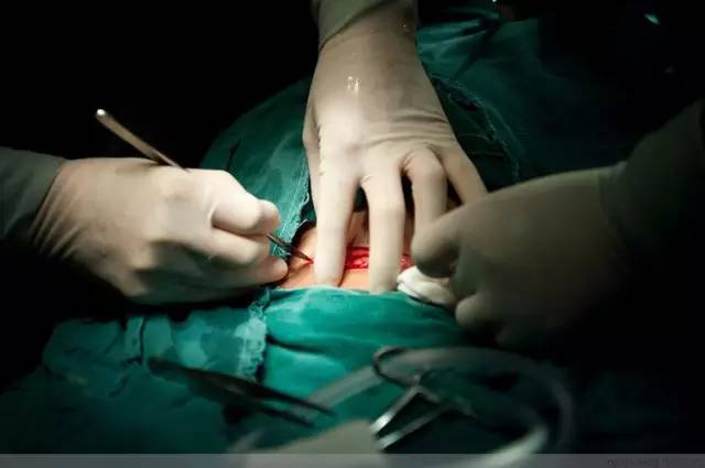 剖腹产全景记录,剖腹产恢复不同时期的照片