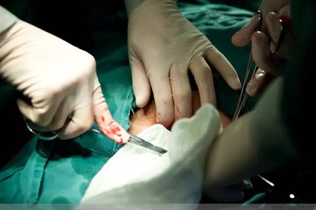 剖腹产全景记录,剖腹产恢复不同时期的照片