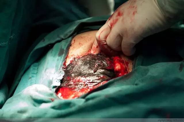 剖腹产全景记录,剖腹产恢复不同时期的照片