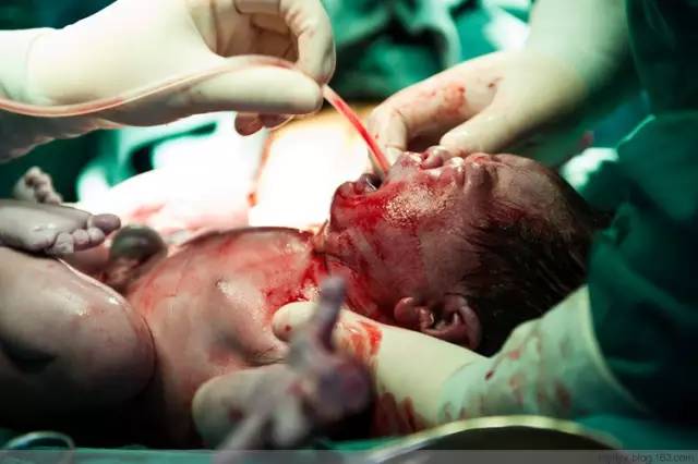 剖腹产全景记录,剖腹产恢复不同时期的照片