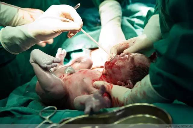 剖腹产全景记录,剖腹产恢复不同时期的照片