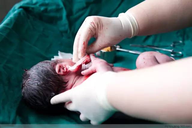 剖腹产全景记录,剖腹产恢复不同时期的照片