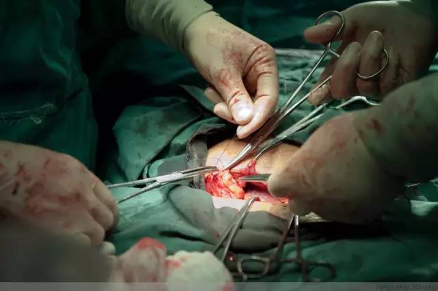 剖腹产全景记录,剖腹产恢复不同时期的照片