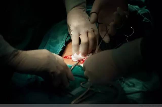 剖腹产全景记录,剖腹产恢复不同时期的照片