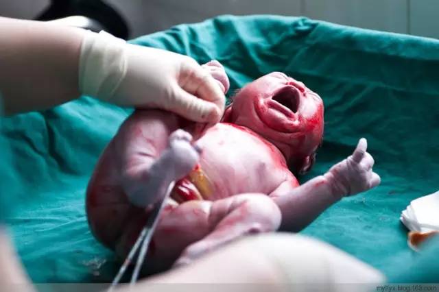 剖腹产全景记录,剖腹产恢复不同时期的照片