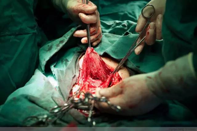 剖腹产全景记录,剖腹产恢复不同时期的照片