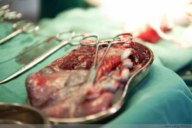 剖腹产全景记录,剖腹产恢复不同时期的照片