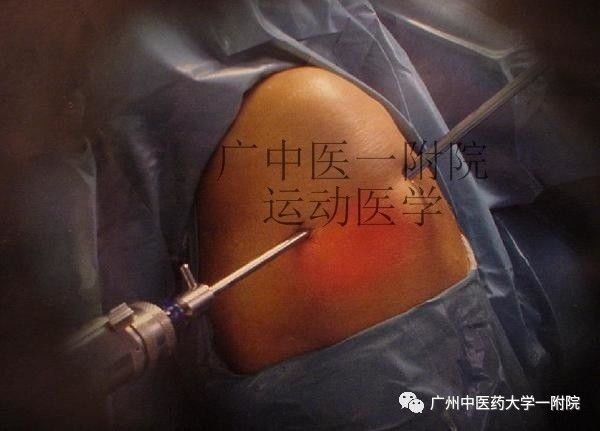 养生堂半月板损伤怎样修复,半月板损伤针灸还是封闭治疗好