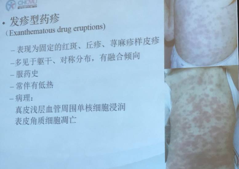 幼儿麻疹的鉴别方法,儿童麻疹的诊断与治疗