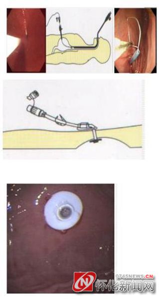 湖南医药学院第一附属医院成功为一气管食管瘘危重患者实施微创治疗