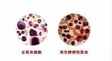 儿童慢性再障有自愈的吗,儿童再障患者的概率