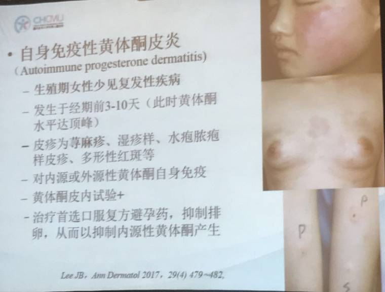 幼儿麻疹的鉴别方法,儿童麻疹的诊断与治疗