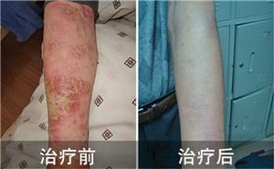 患者既往治疗史堪称“上当受骗教科书”潍坊治愈露笑容