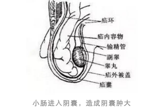 疝气常见病,小儿疝气是常见病么