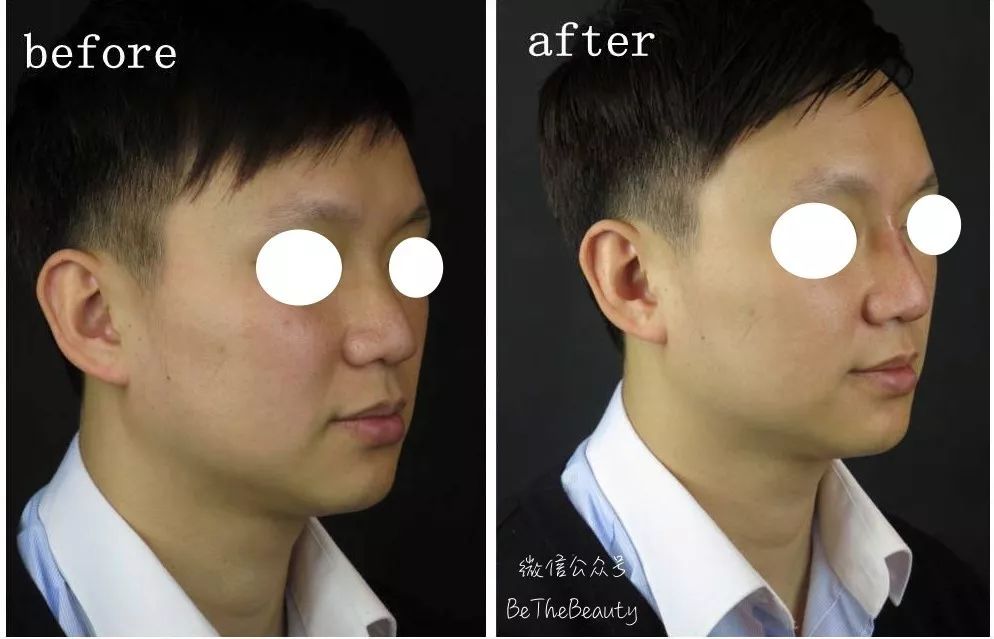 鼻翼宽鼻头大怎么办,塌鼻子鼻翼宽妆容