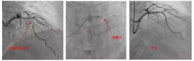 复杂冠状动脉病变,冠状动脉粥样硬化防治