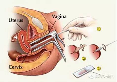 宫颈刮片多久可以拿报告,宫颈刮片图片报告单