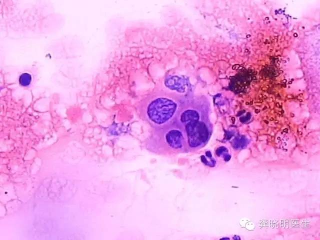 宫颈刮片多久可以拿报告,宫颈刮片图片报告单