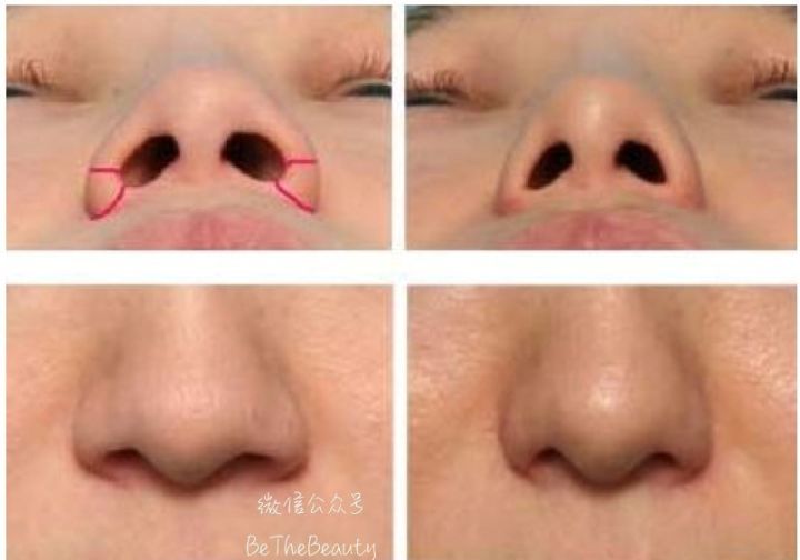 鼻翼宽鼻头大怎么办,塌鼻子鼻翼宽妆容